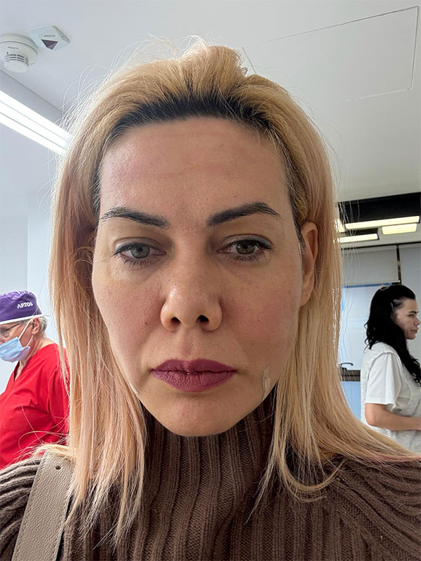 Lifting facial cu fire Aptos - Doctor SKiN Lifting facial cu fire Aptos - Doctor SKiN