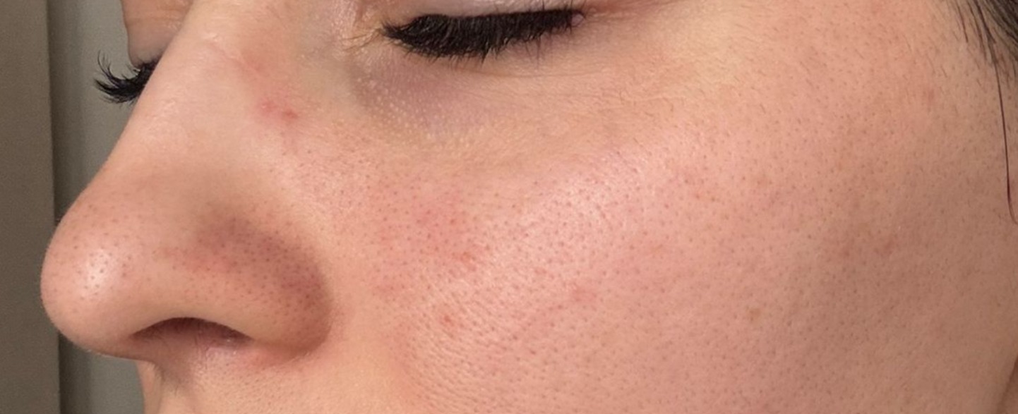 1 sedinta de laser CO2 Doctor Skin