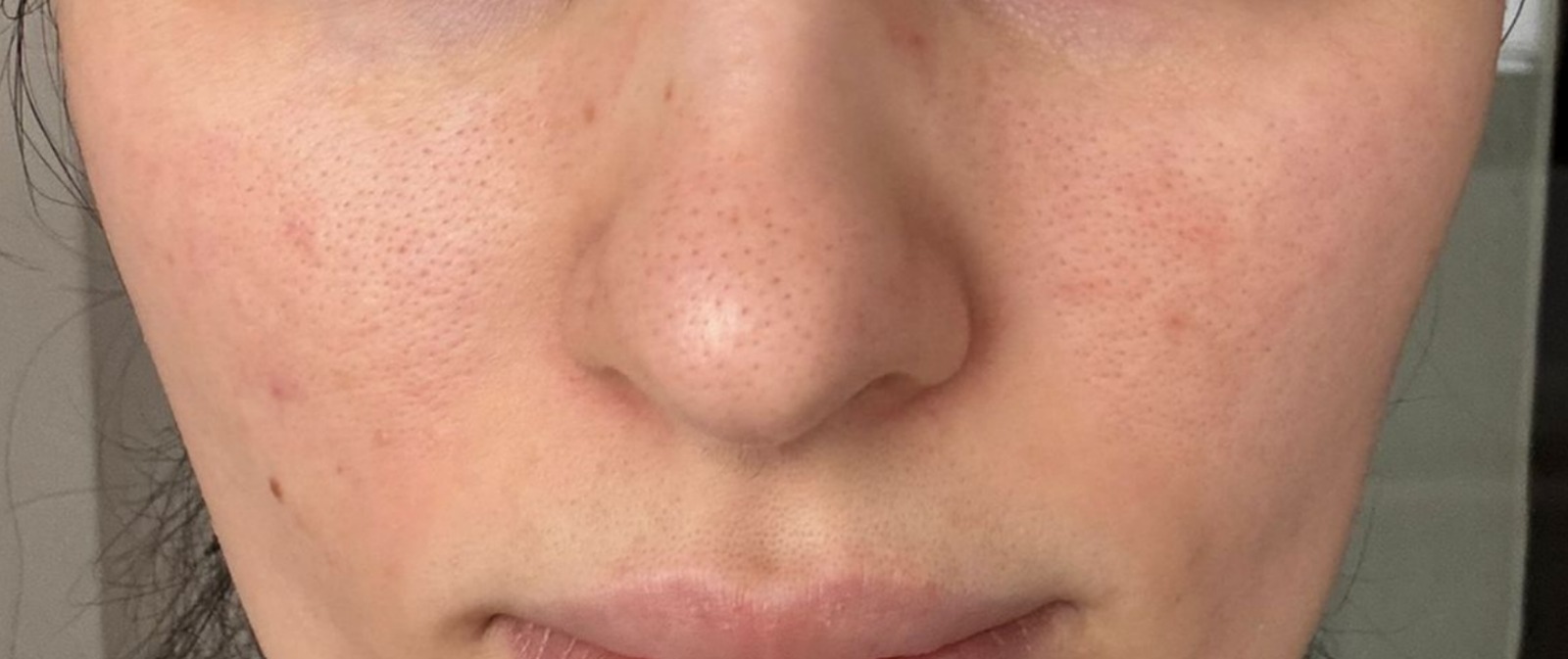 tratament pori mariti Doctor Skin