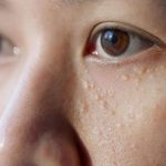 îndepărtare milia (puncte de grăsime)