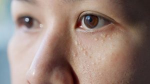 îndepărtare milia (puncte de grăsime)