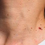 îndepărtare papiloame