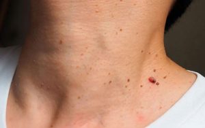 îndepărtare papiloame