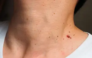 îndepărtare papiloame