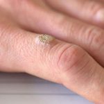 Tratament veruci (negi) - Doctor SKiN tratament veruci, negi