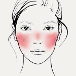 Cuperoză și rozacee - Doctor SKiN tratament roșeață facială, cuperoză, rozacee