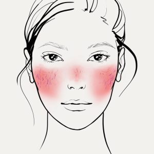 tratament roșeață facială, cuperoză, rozacee