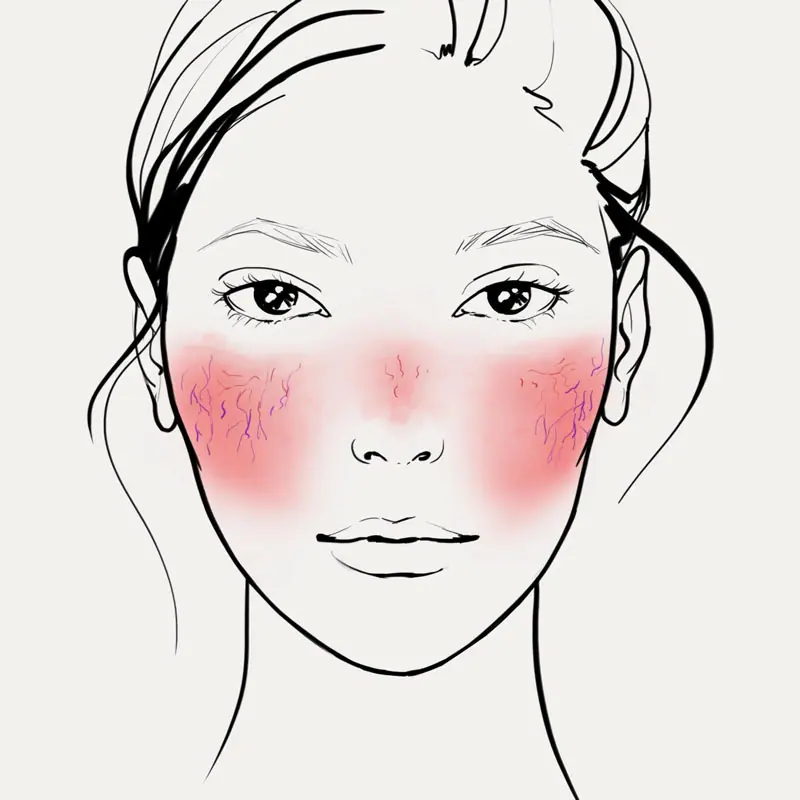 tratament roșeață facială, cuperoză, rozacee