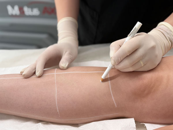 Deka Motus AX – Laser Alexandrite 6000W. Standardul de Aur pentru fire fine și păr rezidual - Doctor SKiN epilare personalizata doctor skin